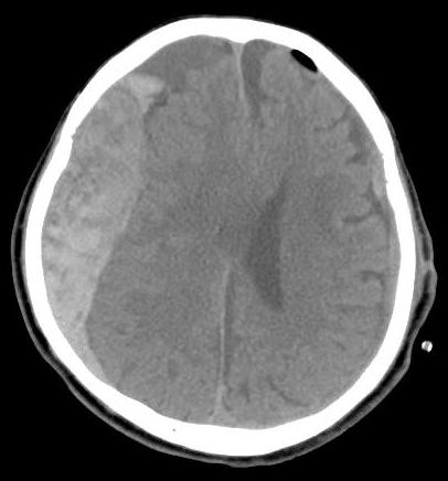 Contralateral Delayed Acute Subdural Hematoma Following Evacuation of a ...