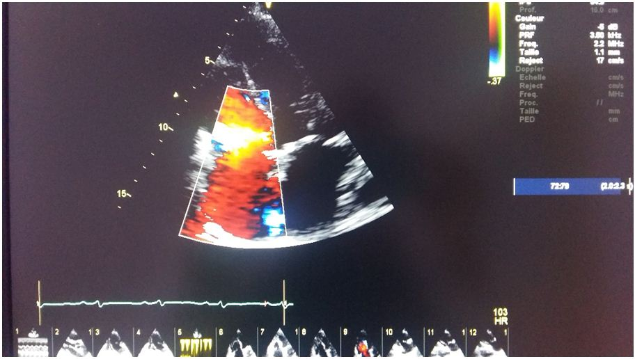 Infective Endocarditis at Tricuspid Valve in CHD: What are its ...